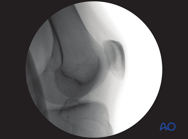 Verification of optimal accessory view of the medial facet