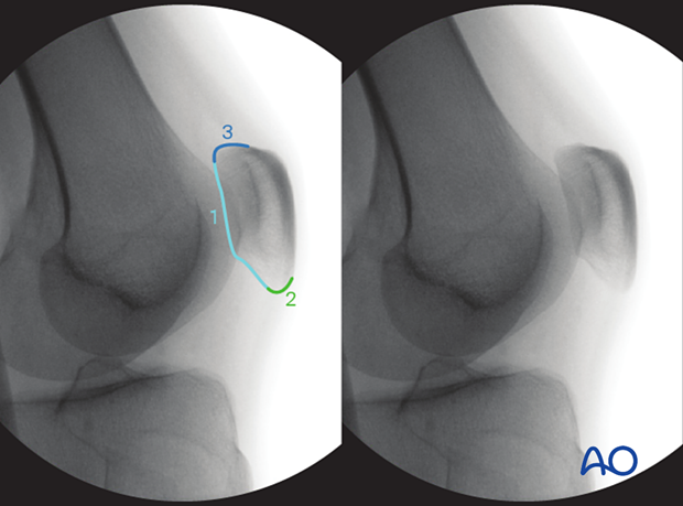 34 X550 Intraoperative imaging of the patella