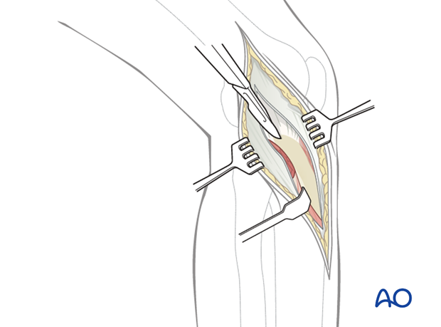 anterolateral approach