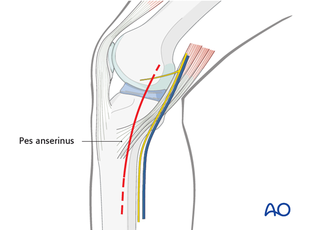 medialposteromedial approach