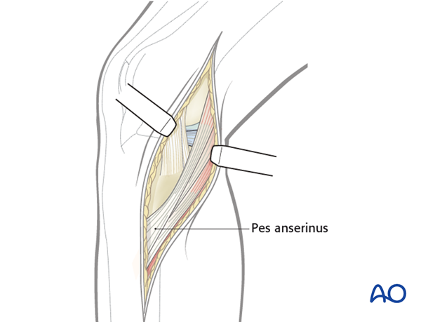 medialposteromedial approach