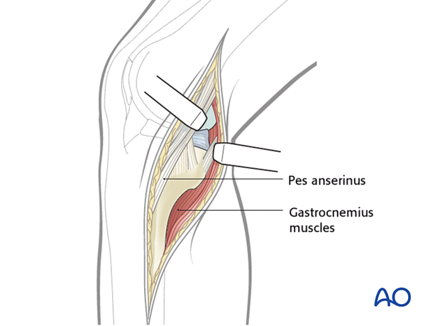 medialposteromedial approach