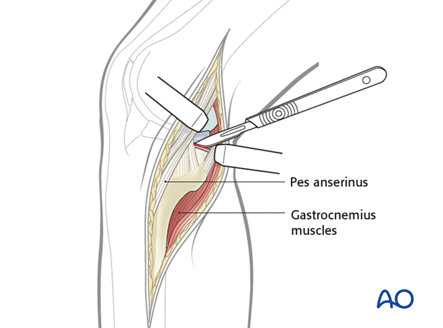 medialposteromedial approach