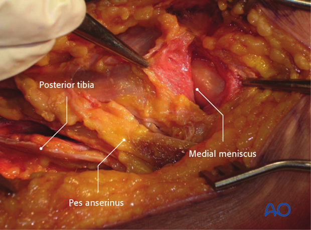 medialposteromedial approach