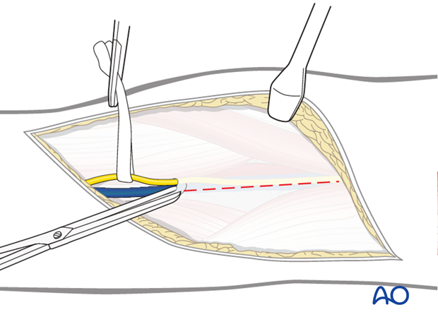 posterior approach