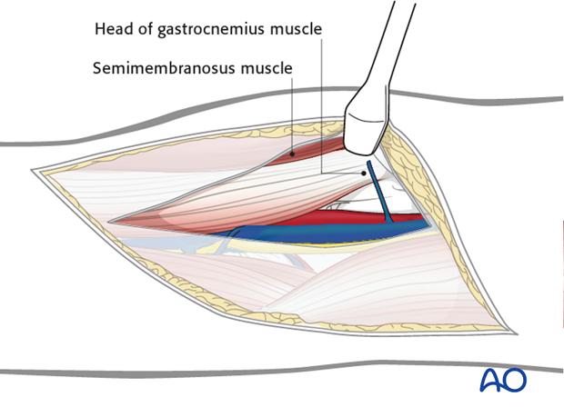 posterior approach