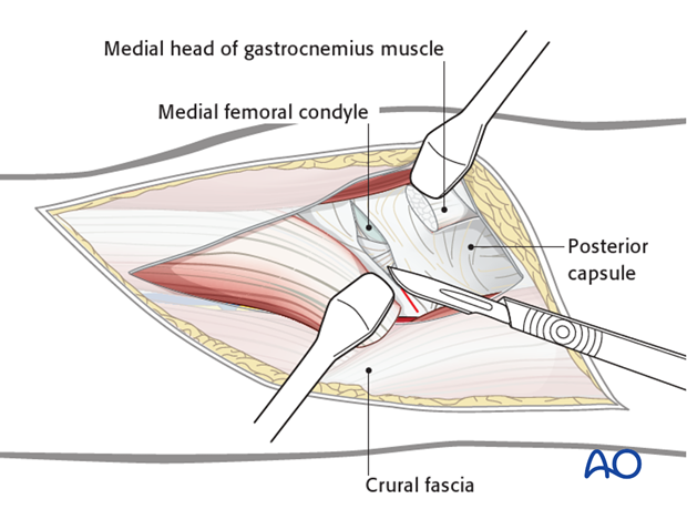 posterior approach