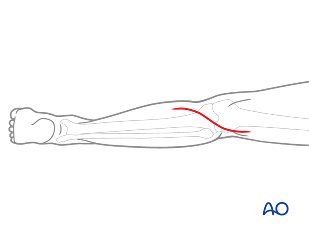 posterior approach