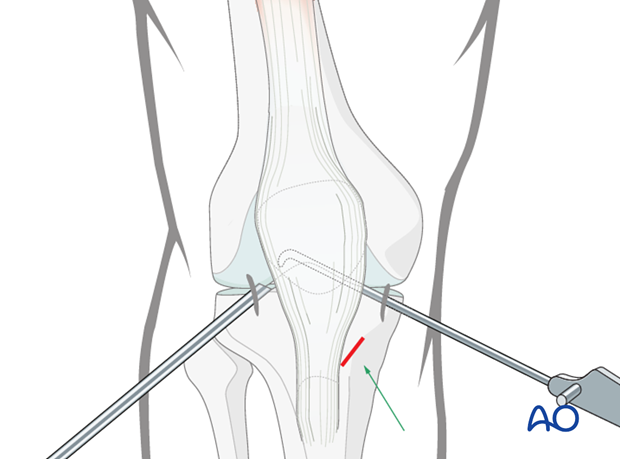 arthroscopic approach to the knee