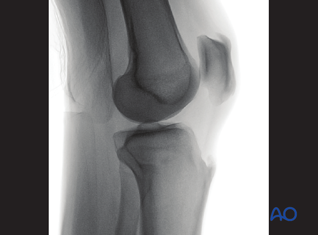 41 X552 Intraoperative imaging of the proximal tibia