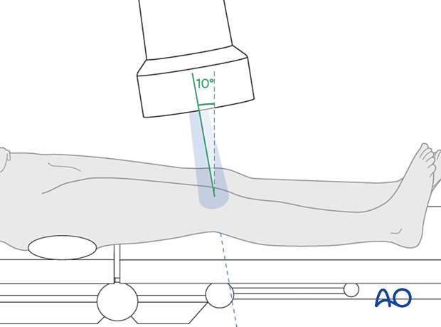 Positioning for optimal AP view of the proximal tibia with 10° cephalic tilt