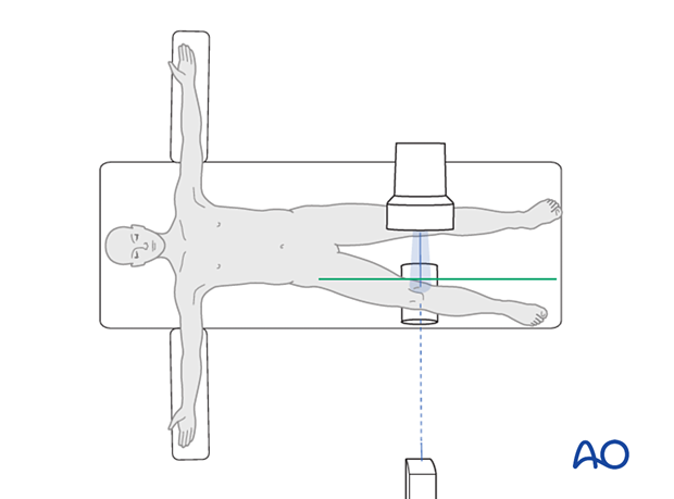 Positioning for optimal modified lateral view to evaluate the lateral plateau