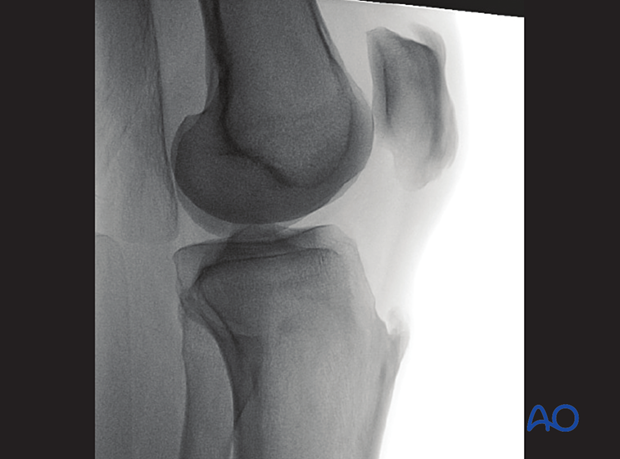 Verification of optimal view for optimal modified lateral view to evaluate the medial plateau