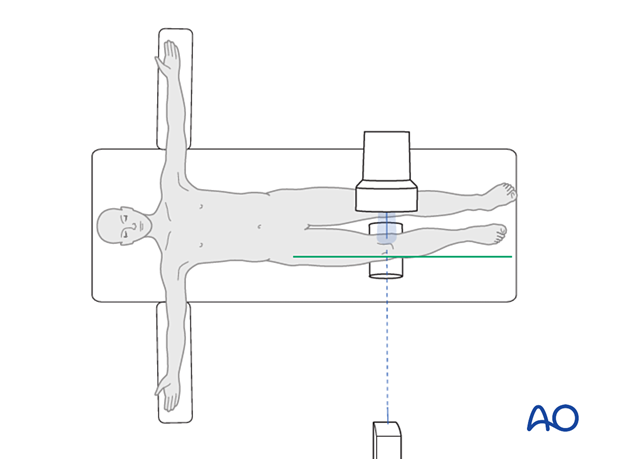 Positioning for optimal modified lateral view to evaluate the medial plateau