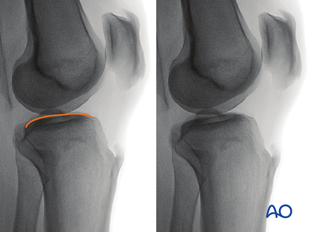 Anatomical landmarks and lines in the modified lateral view to evaluate the lateral plateau