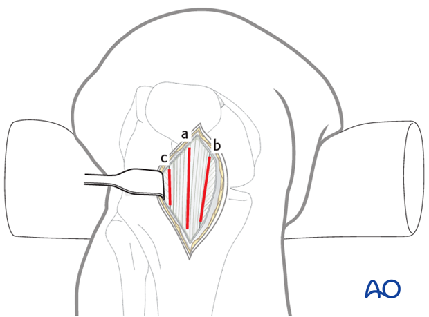 nailing limited open approach to the distal tibia