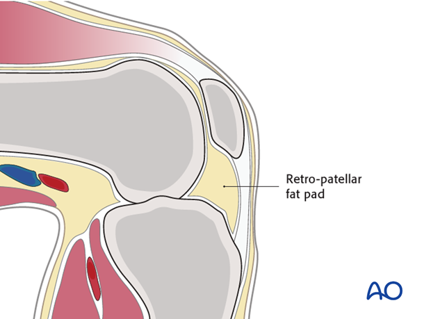 nailing limited open approach to the distal tibia