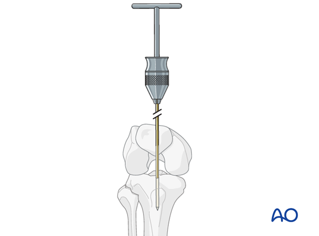 nailing limited open approach to the distal tibia