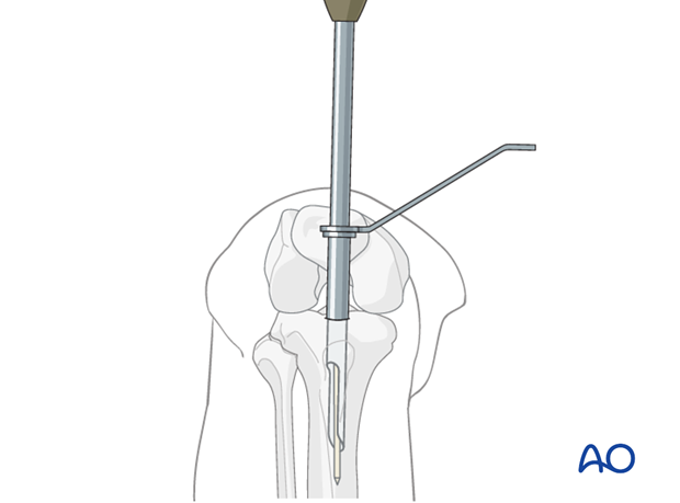 nailing limited open approach to the distal tibia