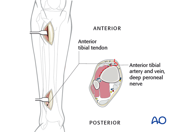 Distal incision