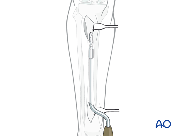 Prepare a tunnel between the anterior tibial muscle and the periosteum.