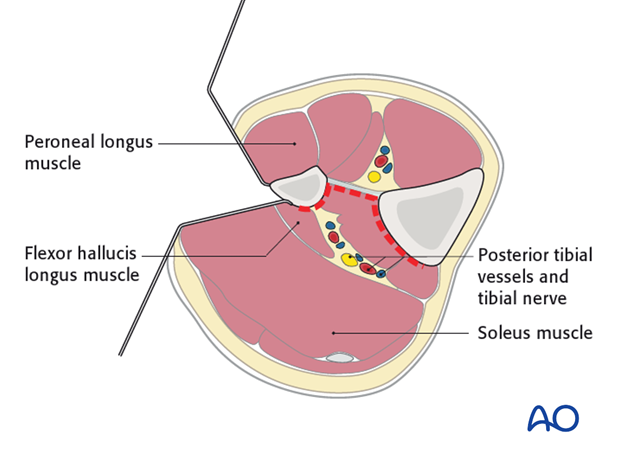 The plane of the dissection will be between the superficial posterior and lateral compartments.