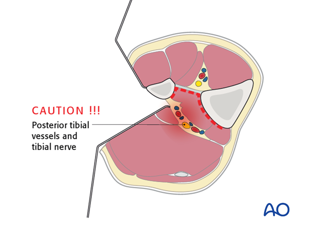 One should proceed with caution when mobilizing the deep posterior compartment.