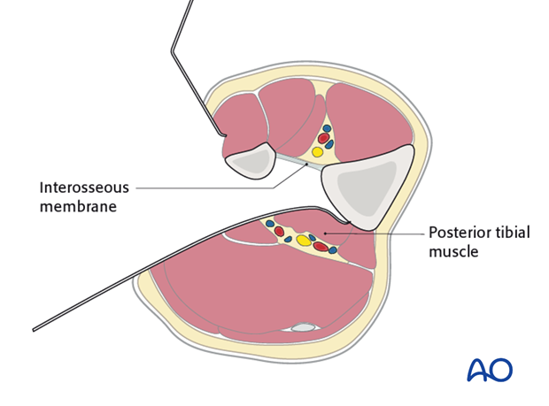 Mobilize the remainder of the deep posterior compartment medialwards until the posterior aspect of the tibia is encountered.