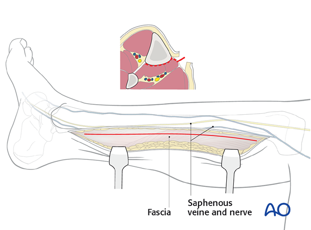 Dissection