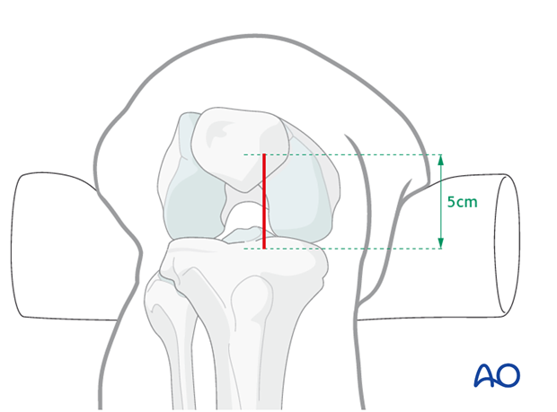 Determination of the entry point