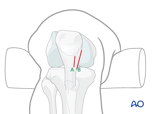 Tendon incision