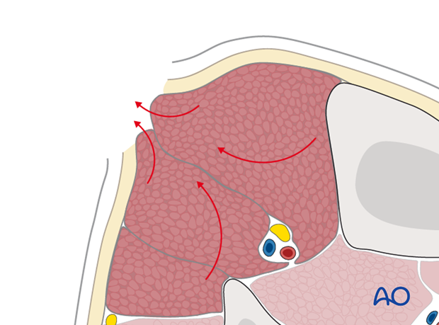 compartment syndrome