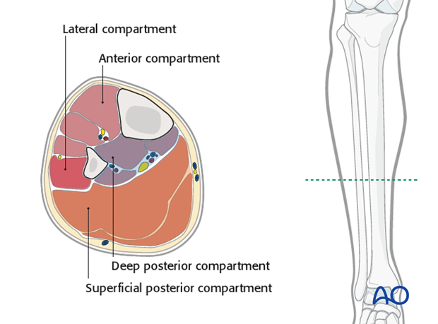 compartment syndrome