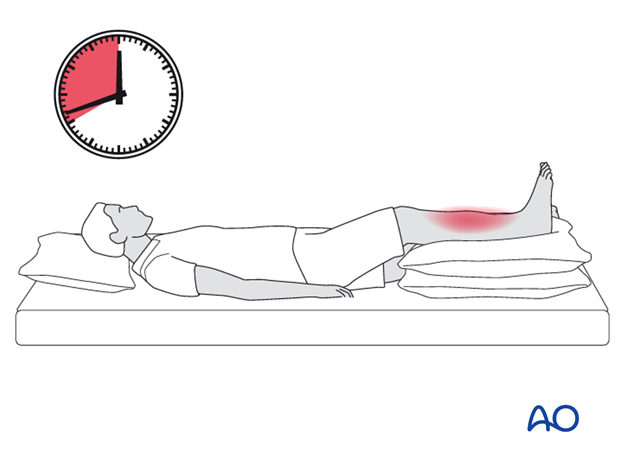 compartment syndrome