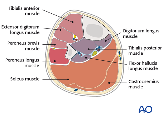 compartment syndrome