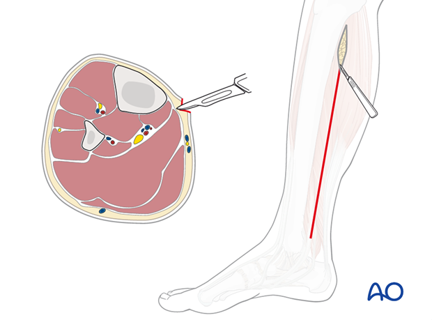 compartment syndrome