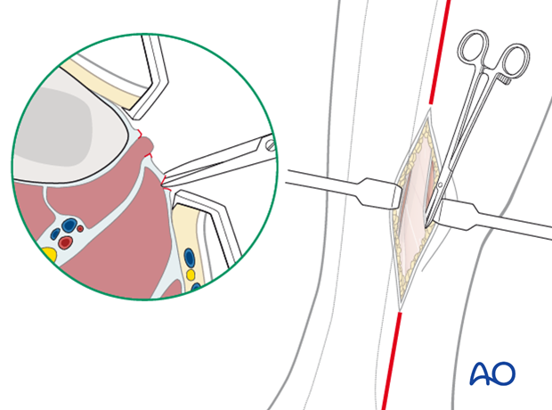 compartment syndrome