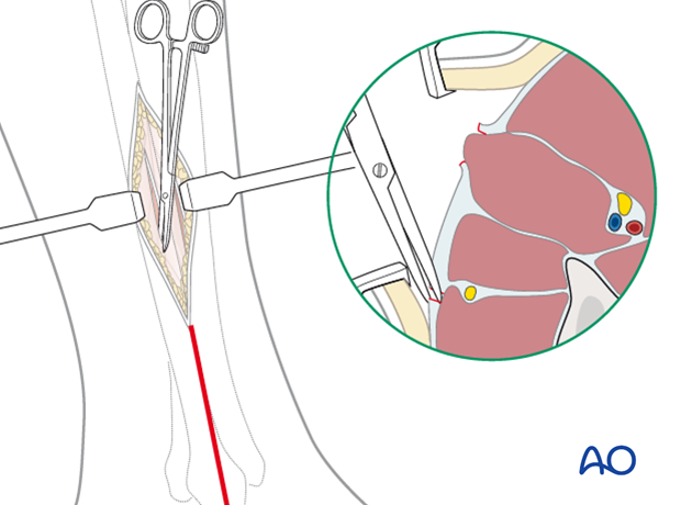 compartment syndrome