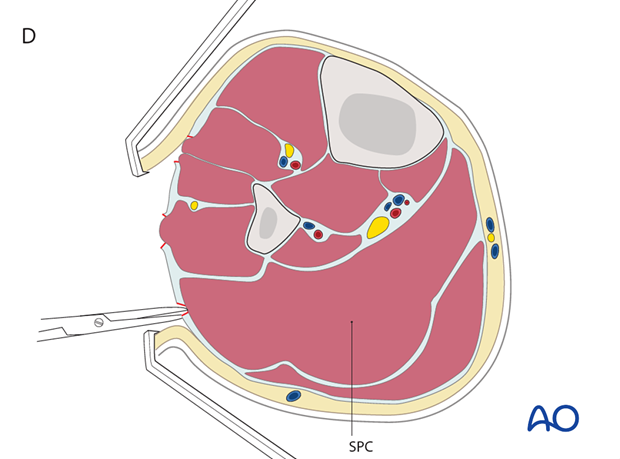 compartment syndrome