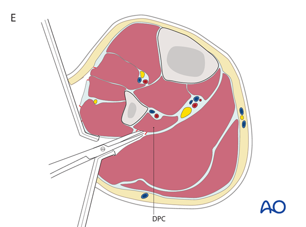 compartment syndrome