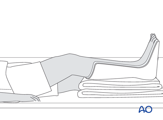 compartment syndrome