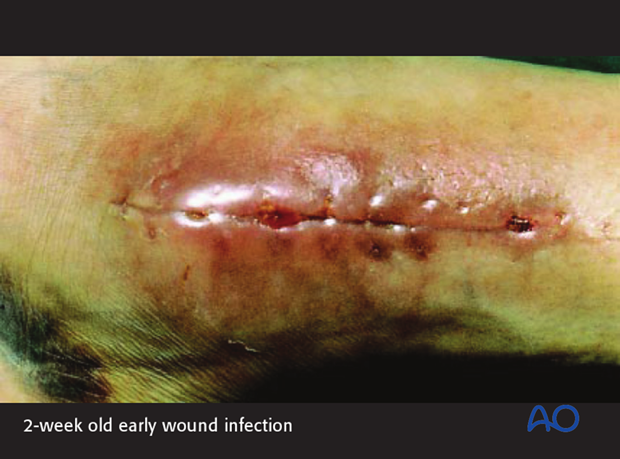 classifications of wound infection