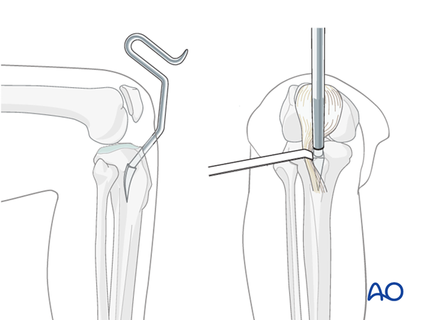 nailing limited open approach to the distal tibia