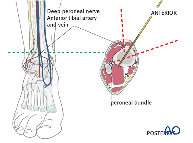 safe zones of the tibia for pin insertion