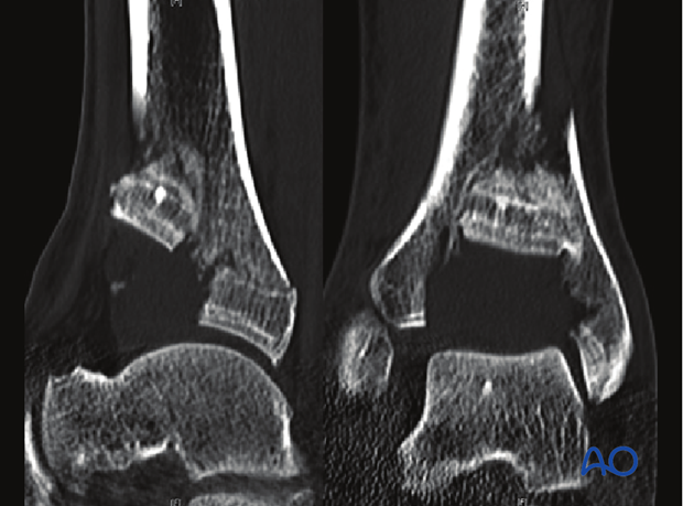 anteromedial approach to the distal tibia