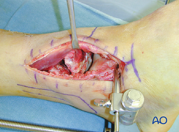 anterolateral approach to the distal tibia