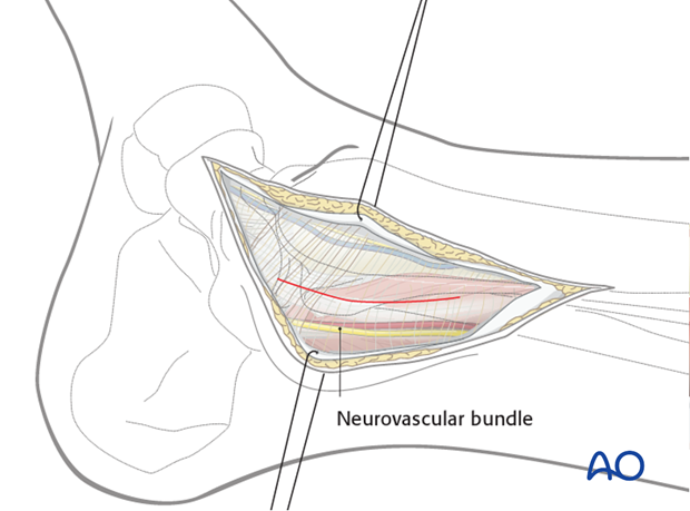 posteromedial approach to the distal tibia