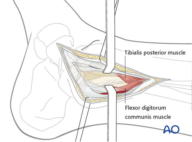 posteromedial approach to the distal tibia