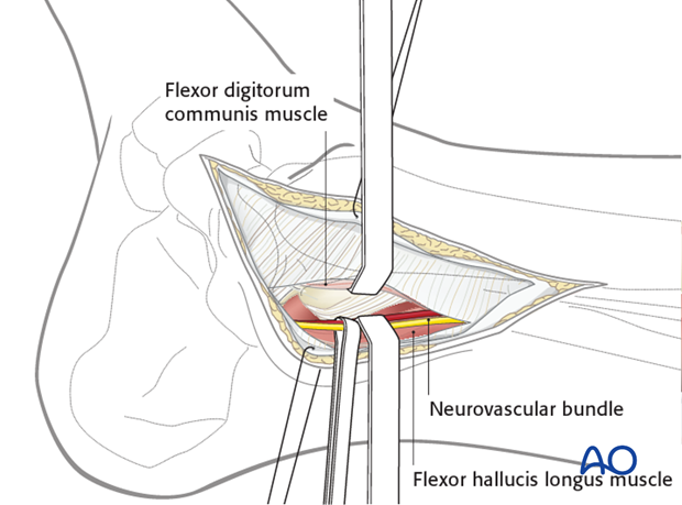 posteromedial approach to the distal tibia