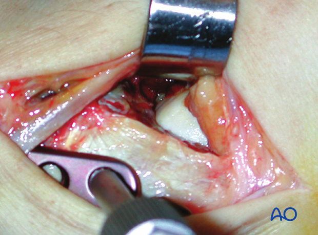 minimally invasive approach to the distal tibia